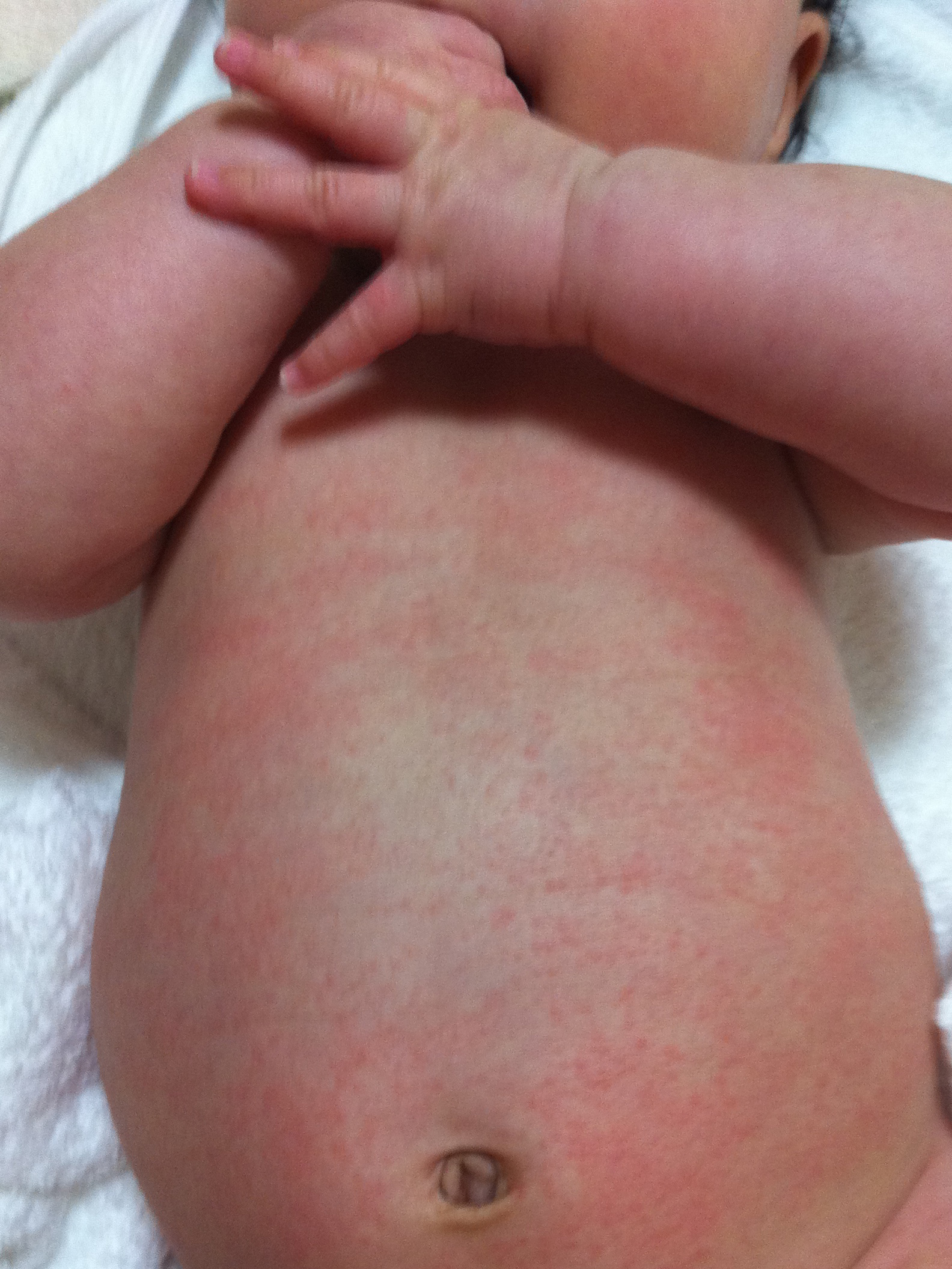 乳児 湿疹 ヒルドイド ヒルドイドローションは赤ちゃんの乳児湿疹にも安心 副作用はこれだけ
